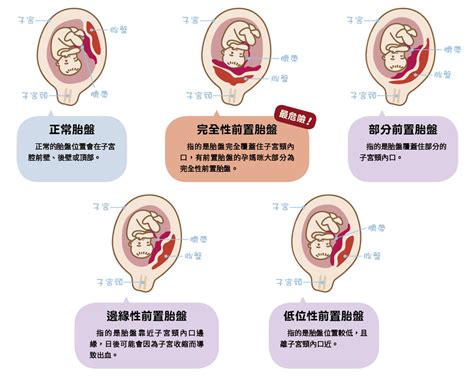 前置胎盤剝離|認識「前置胎盤」4種型態及主要症狀｜Mombaby 媽 